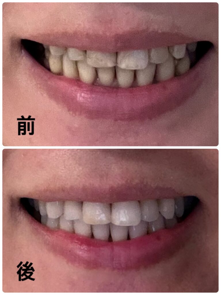 ビフォーアフター（歯の色）